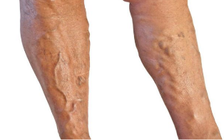 Traitement des varices dans les jambes.