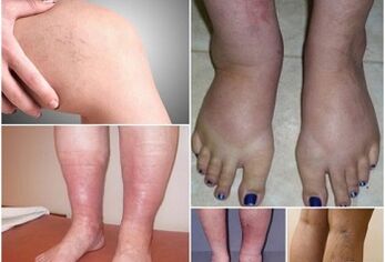 Photos de manifestations de varices sur les jambes