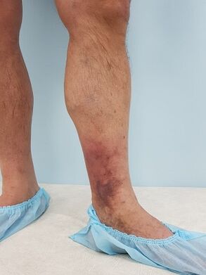 Complications des varices chez les hommes