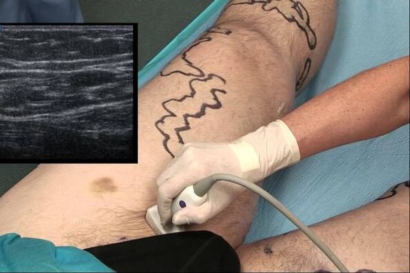 Diagnostic des varices chez l'homme