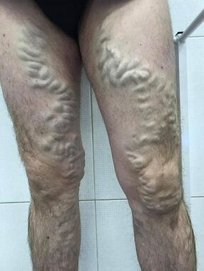 varices masculines négligées