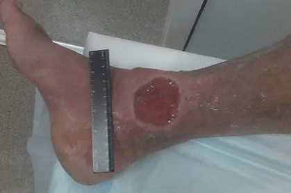Complications des varices
