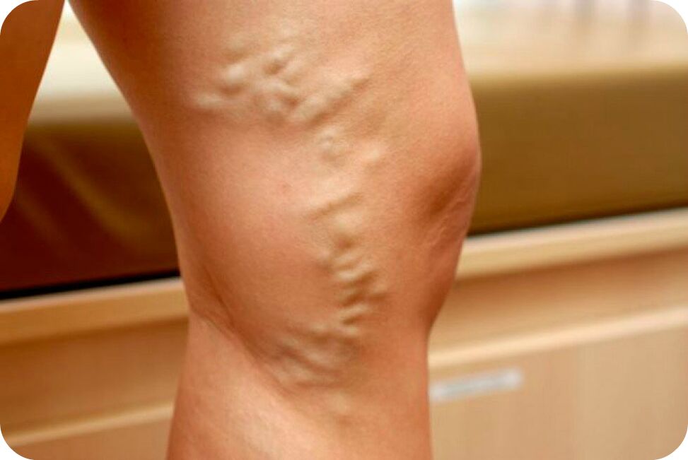 Varices des veines