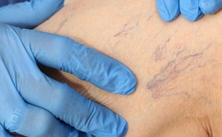 Symptômes de varices