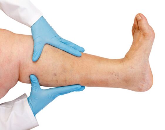 Varices sur les jambes