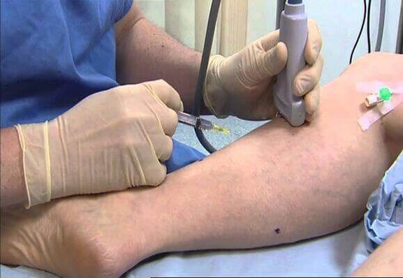 Traitement des varices