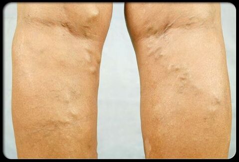 Varices sur les jambes